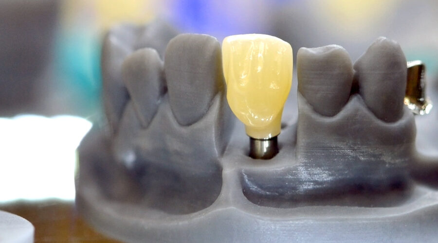 implant stomatologiczny wykonany w technologii 3d - dental implant made in 3d technology - zubný implantát vyrobený 3D technológiou